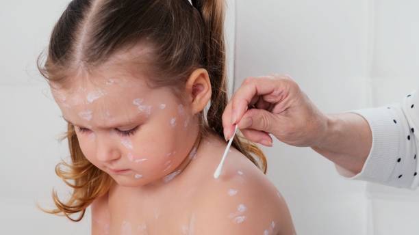 trauriges kleines mädchen mit windpocken, antiseptische creme auf den hautausschlag aufgetragen. hautausschlagsperiode. der resultierende ausschlag sieht aus wie rosa flecken, die sich in papeln verwandeln, von denen einige. bei hautausschlägen tritt ein - chickenpox skin condition baby illness stock-fotos und bilder