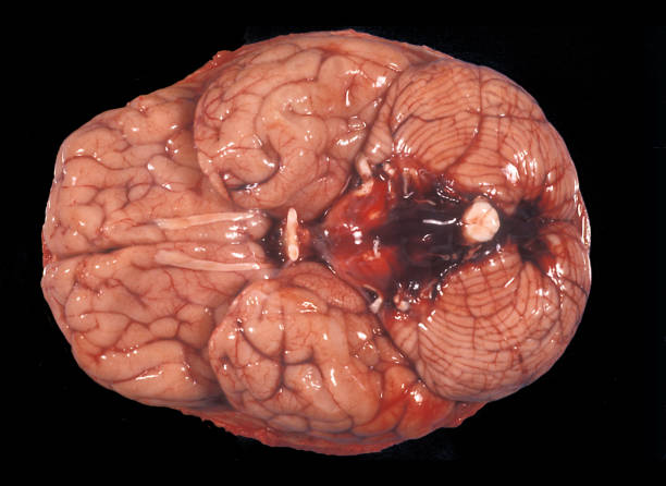 人間の脳。くも膜下出血 - gyrus ストックフォトと画像
