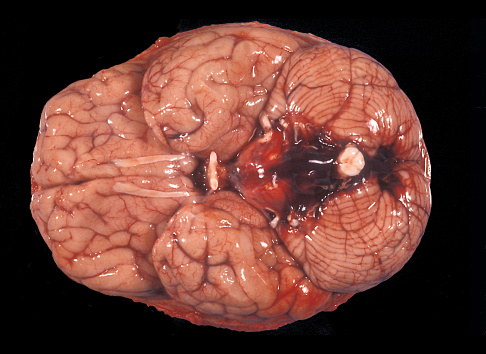 Human brain. Basal subarachnoid hemorrhage