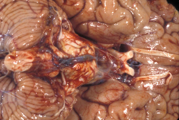 인간의 뇌. 폰과 수둘라의 수브라크누이 드 확산 출혈 - medulla oblongata 뉴스 사진 이미지