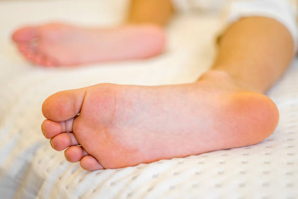 Treatment and prevention of flat feet in children