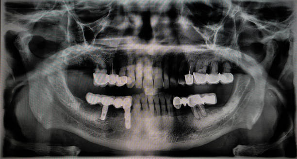 istock Dental X-ray of a senior old man. 1354564976