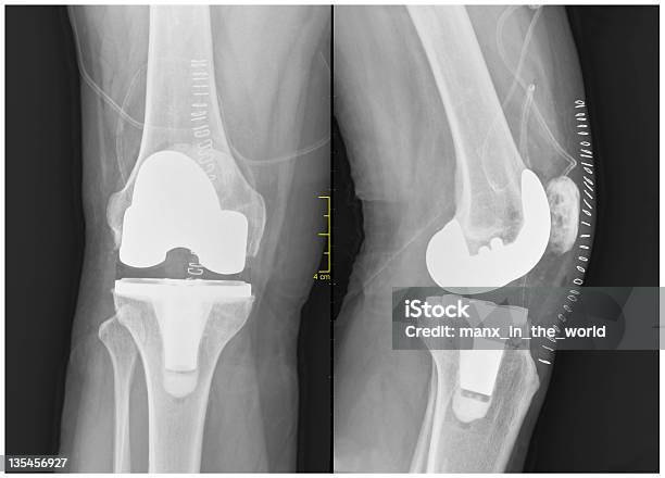 Insgesamt Knie Erneuerung Stockfoto und mehr Bilder von Künstliches Kniegelenk - Künstliches Kniegelenk, Röntgenbild, Naht - Medizinisches Material