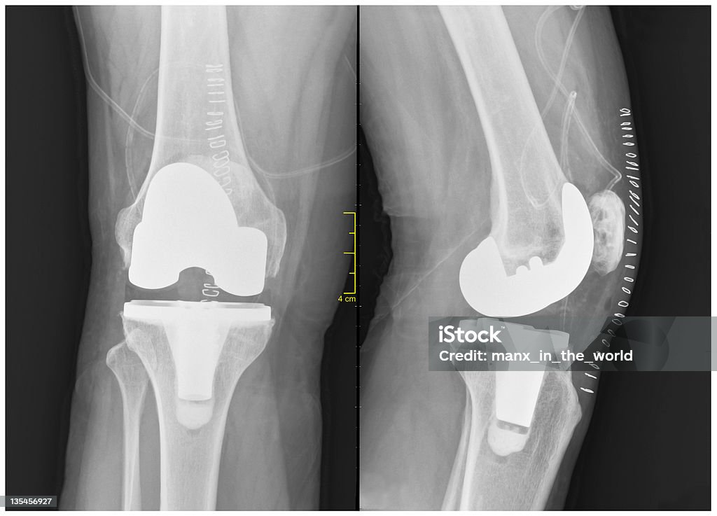 Artroplastia Total de la rodilla - Foto de stock de Rodilla artificial libre de derechos