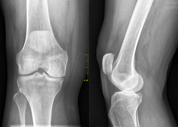 istock RX of damaged knee cartilage 135456988