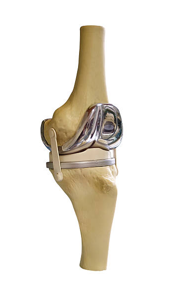Total Knee Replacement A model of a Total Knee Replacement artificial knee photos stock pictures, royalty-free photos & images