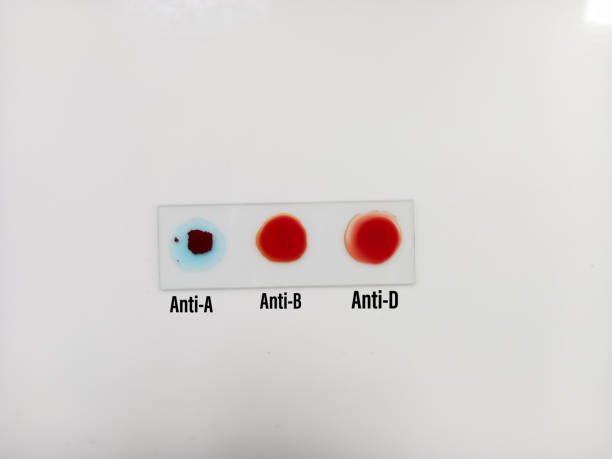istock Blood group testing by slide agglutination method , A Negative blood grouping. medical concept 1354582710