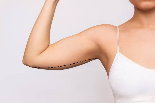 una giovane donna con grasso in eccesso sulla parte superiore del braccio con segni per la liposuzione o la chirurgia plastica - liposuction foto e immagini stock