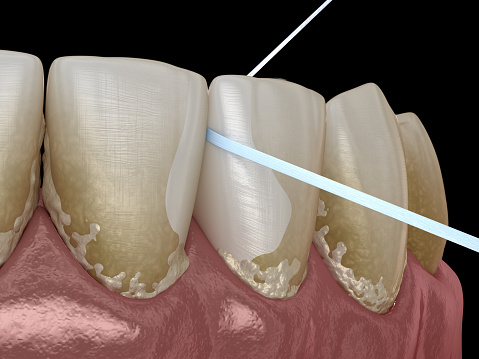 Oral hygiene: using dental floss for plaque removing. Medically accurate dental 3D illustration