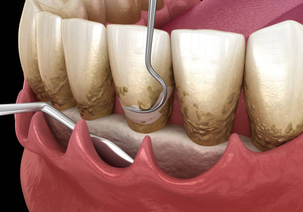 istock Open curettage: Scaling and root planing (conventional periodontal therapy). Medically accurate 3D illustration of human teeth treatment 1354818244