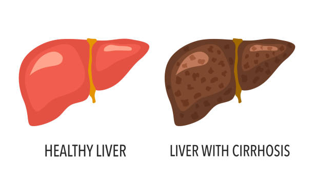 Comparison of healthy liver and liver cirrhosis disease. Human liver organ anatomy vector illustration on white background. Comparison of healthy liver and liver cirrhosis disease. Human liver organ anatomy vector illustration on white background. cirrhosis stock illustrations