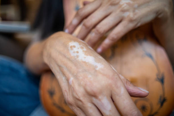 istock Living with vitiligo 1354891198
