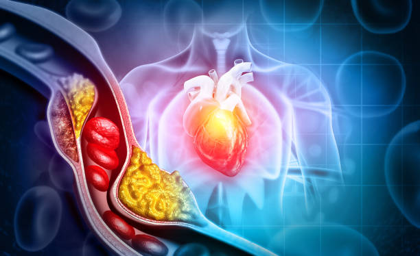 el colesterol bloqueó la arteria con el corazón. ilustración 3d - cholesterol fotografías e imágenes de stock