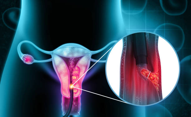 팽창 및 큐레티지 (d 및 c).자궁내막 생검.자궁경부암.3d 일러스트 - cramping 뉴스 사진 이미지
