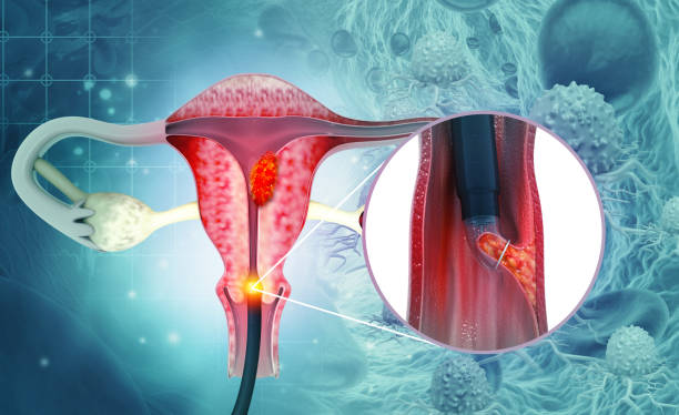 дилатация и кюретаж (d и c).биопсия эндометрия.рак шейки матки.3d иллюстрация - cramping стоковые фото и изображения