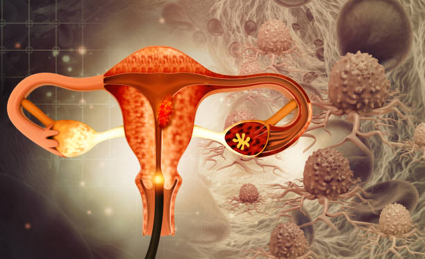дилатация и кюретаж (d и c).биопсия эндометрия.рак шейки матки.3d иллюстрация - cramping стоковые фото и изображения
