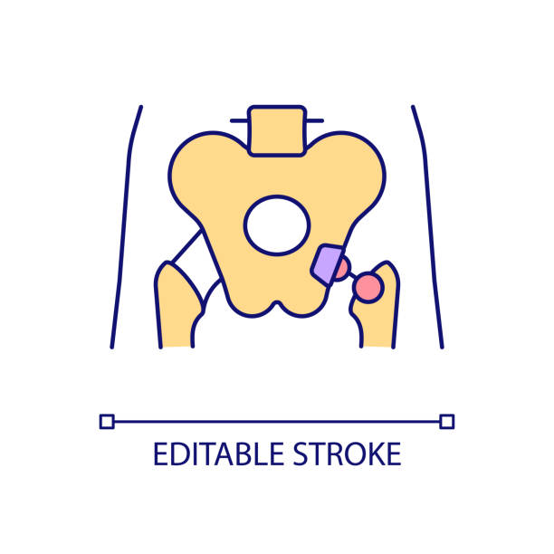 Hip replacement RGB color icon Hip replacement RGB color icon. Artificial prothesis. Metal joint implant. Surgical treatment. Body part. Damage consequence. Isolated vector illustration. Simple filled line drawing. Editable stroke hip replacement stock illustrations