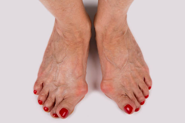 piedi deformati sulla donna, sfondo grigio - podiatrist pedicure human foot toenail foto e immagini stock