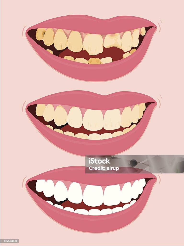 Progressive Stages Of Tooth Decay caries Progressive Stages Of Tooth Decay, illustration of open female mouth showing three steps to rotten teeth Rotting stock vector