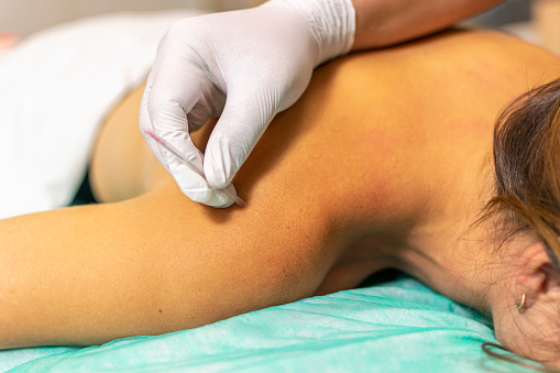 Detail of Young Caucasian woman receiving a dry needling treatment. Selective Focus