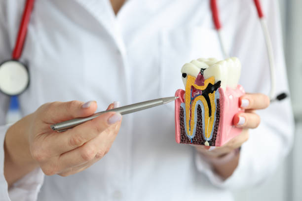 médico que muestra cavidad cariosa con bolígrafo en primer plano modelo de diente artificial de plástico - carie dental fotografías e imágenes de stock