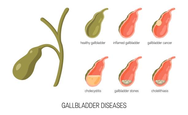 Gall bladder diseases in cartoon style, vector Gallbladder diseases. Bile duct concept. Anatomical icons for medical designs. Vector illustration isolated on a white background in cartoon style. gall bladder stock illustrations