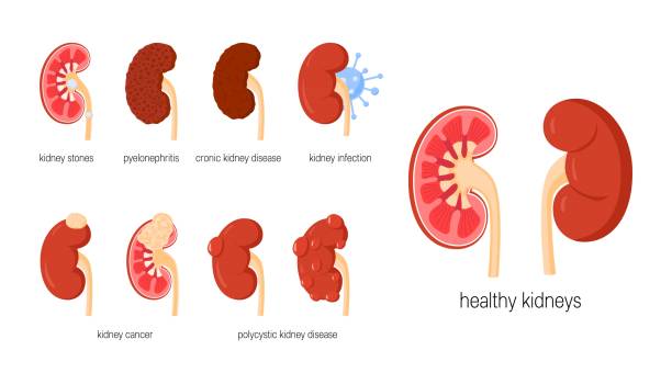 ilustraciones, imágenes clip art, dibujos animados e iconos de stock de concepto de enfermedades renales en estilo plano, vector - kidney cancer