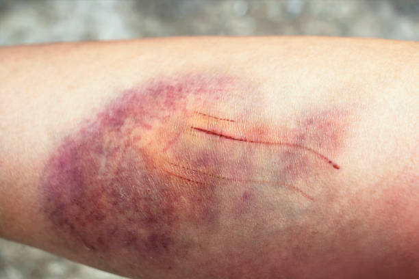 The bruises and wound form scabs on legs. The wound happen during woman Injuries from accident falling down on road. The bruises and wound form scabs on legs. The wound happen during woman Injuries from accident falling down on road. bruise photos stock pictures, royalty-free photos & images