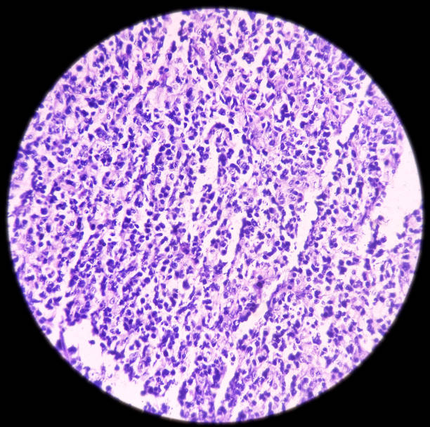 linfonodo inguinal: linfoma não-hodgkin, alto grau - non hodgkin lymphoma - fotografias e filmes do acervo