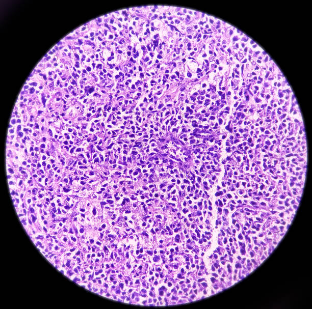 linfonodo inguinale: linfoma non-hodgkin, alto grado - hodgkins disease foto e immagini stock