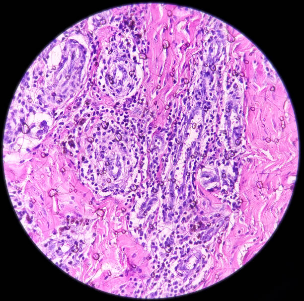 Pilonidal Abscess Child 10+ Pilonidal Abscess Stock Photos, Pictures & Royalty-Free Images - iStock