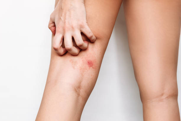 a young woman scratching an insect bite on thigh a red rash caused by allergy inflammatory process - horse fly imagens e fotografias de stock