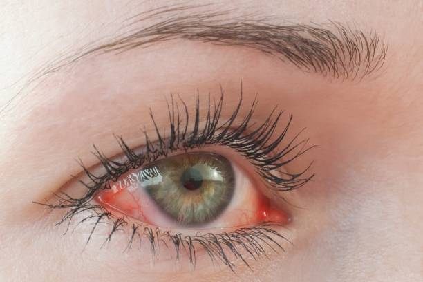 красный раздраженный человеческий глаз крупным планом, симптом аллергии - conjunctiva стоковые фото и изображения