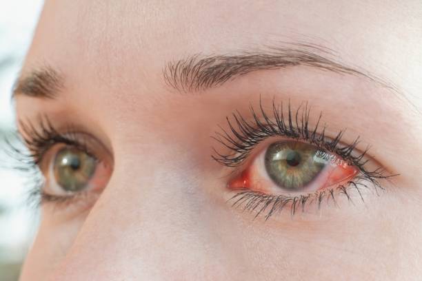 ojo humano rojo irritado de cerca, síntoma de alergia - seco fotografías e imágenes de stock