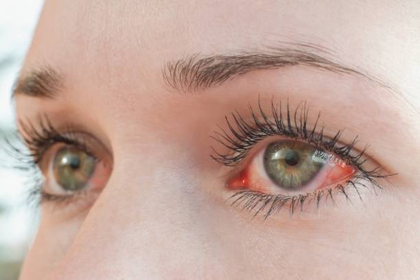 istock Red irritated human eye close up, allergy symptom 1355492204