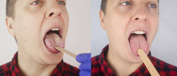 Before and after. White curd on the tongue. A physician or gastroenterologist examines a man tongue. Patient has poor oral hygiene or a symptom of illness. Symptoms of a latent disease. White curd on the tongue. A physician or gastroenterologist examines a man tongue. Patient has poor oral hygiene or a symptom of illness. Symptoms of a latent disease. Before and after. male yeast infection symptoms stock pictures, royalty-free photos & images