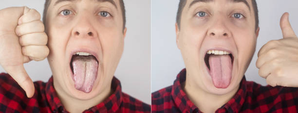 Before and after. White curd on the tongue. A physician or gastroenterologist examines a man tongue. Patient has poor oral hygiene or a symptom of illness. Symptoms of a latent disease. White curd on the tongue. A physician or gastroenterologist examines a man tongue. Patient has poor oral hygiene or a symptom of illness. Symptoms of a latent disease. Before and after. male yeast infection symptoms stock pictures, royalty-free photos & images