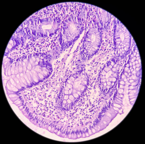 istock Ileum histology, Chronic granulomatous inflammation histologically consistent with tuberculosis, cluster of epithelioid cells, lymphocytes and histiocytes in the lamina 1355598264