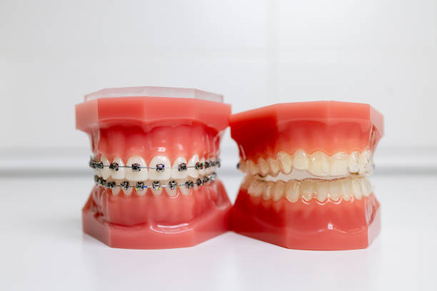 mundschutz und modelle von zähnen mit zahnspangen auf zähnen an einem kiefer - laboratory dentures dental hygiene human teeth stock-fotos und bilder
