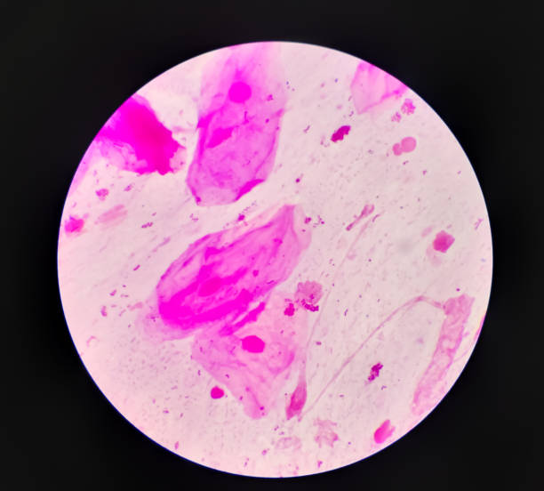 Prostatic smear for Gram Staining microscopic 100x show Neisseria gonorrhoeae bacteria. Gonorrhea is a sexually transmitted disease caused by Neisseria gonorrhoeae bacteria, STD prevention, treatment
