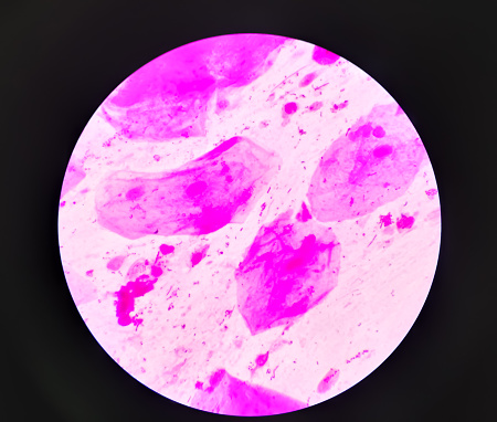 Prostatic smear for Gram Staining microscopic 100x show Neisseria gonorrhoeae bacteria. Gonorrhea is a sexually transmitted disease caused by Neisseria gonorrhoeae bacteria, STD prevention, treatment