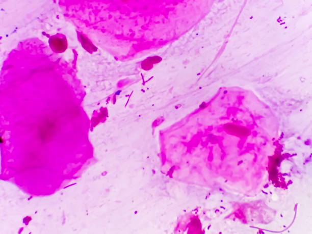 Prostatic smear for Gram Staining microscopic 100x show Neisseria gonorrhoeae bacteria. Gonorrhea is a sexually transmitted disease caused by Neisseria gonorrhoeae bacteria, STD prevention, treatment