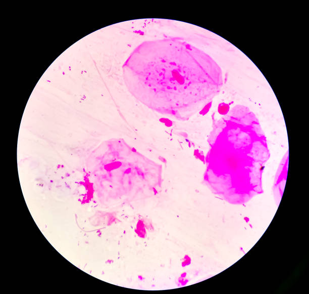 istock Prostatic smear for Gram Staining microscopic 100x show Neisseria gonorrhoeae bacteria. Gonorrhea is a sexually transmitted disease caused by Neisseria gonorrhoeae bacteria, STD prevention, treatment 1355635375