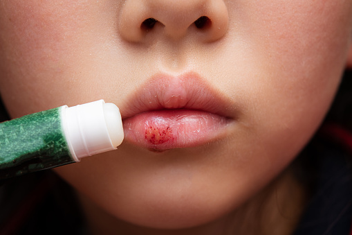거친 입술에 립밤을 바르는 아이 립밤에 대한 스톡 사진 및 기타 이미지 - 립밤, 상처, 입술 - iStock 거친 입술에 립밤을 바르는 아이 립밤에 대한 스톡 사진 및 기타 이미지 - 립밤, 상처, 입술 - Istock