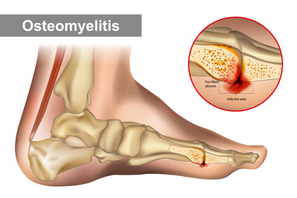 ilustrações, clipart, desenhos animados e ícones de osteomielite é uma infecção óssea. diagrama mostra osteomielite de um osso do pé humano. - pathogen streptococcus life science