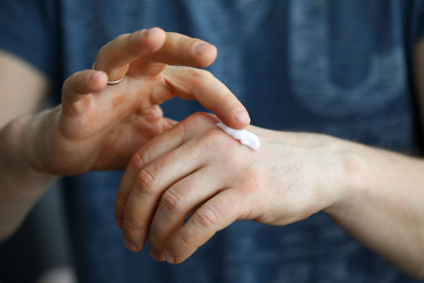 istock Close-up, man applying cream on skin his hand 1355827168