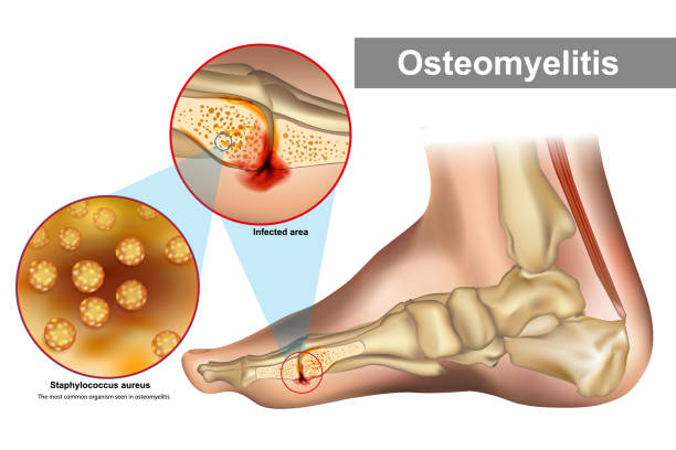 illustrazioni stock, clip art, cartoni animati e icone di tendenza di l'osteomielite è un'infezione dell'osso. staphylococcus aureus organismo più comune visto nell'osteomielite - coccus