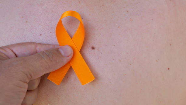 holding an orange tape over the skin with spots. campaign to prevent skin cancer, melanoma, December orange holding an orange tape over the skin with spots. campaign to prevent skin cancer, melanoma, December orange skin cancer stock pictures, royalty-free photos & images