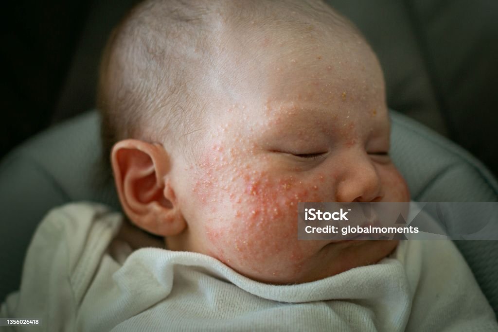 A newborn baby suffering from baby acne, cradle cap, and eczema on the face and cheeks. A little baby suffering from skin problems with red spots on her face. Baby - Human Age Stock Photo