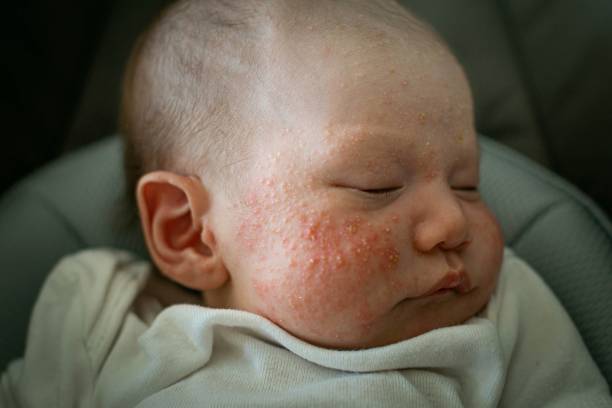 A newborn baby suffering from baby acne, cradle cap, and eczema on the face and cheeks. stock photo